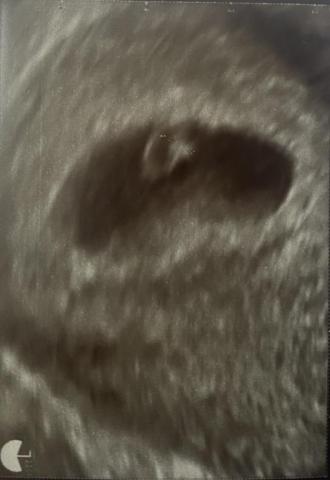 他人の子種で妊娠成功